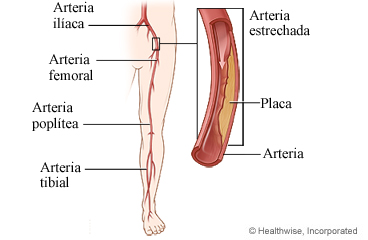 Arteria estrechada con placa en la pierna