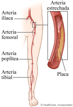 Una arteria de la pierna estrechada por placa