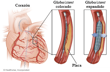 Stent colocado en una arteria coronaria