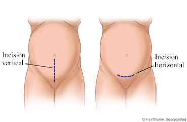 Incisiones de cesárea, tanto vertical como horizontal