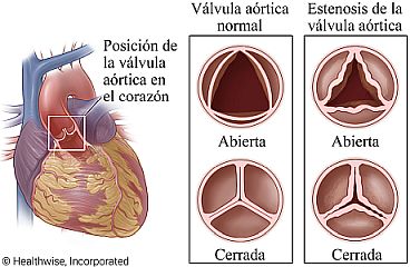 Válvula aórtica normal y estenosis de la válvula aórtica