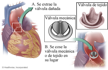 Válvulas mecánicas y de tejido, y el lugar donde se colocan en el corazón