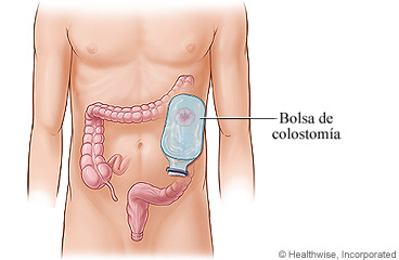 Bolsa de colostomía