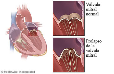 Válvula mitral normal y prolapso de la válvula mitral