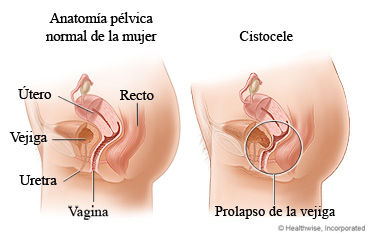 Anatomía pélvica normal de la mujer y un cistocele