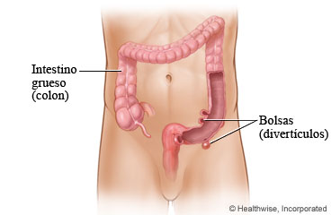 Bolsas llamadas divertículos en el intestino grueso