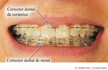 Correctores dentales de cerámica y de metal