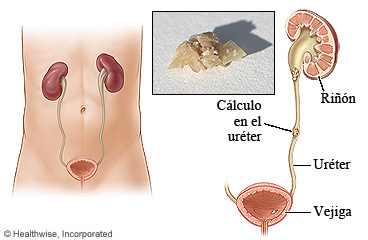 Un cálculo renal en el uréter