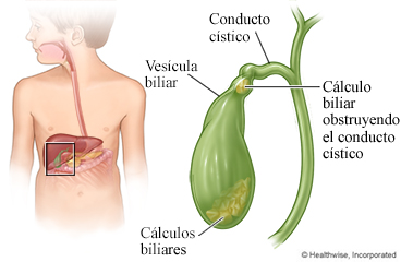 Cálculo biliar en el conducto cístico