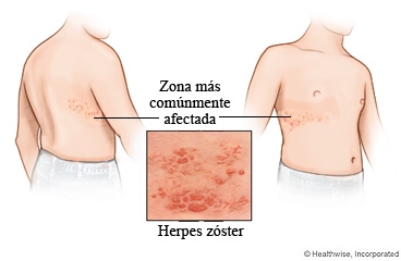 Herpes zóster (culebrilla)