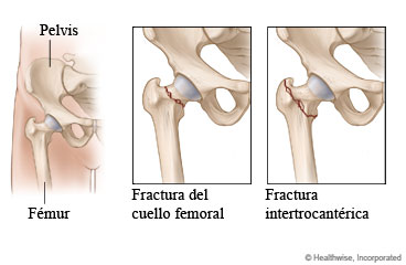 Imagen de la cadera y dos tipos de fractura de cadera