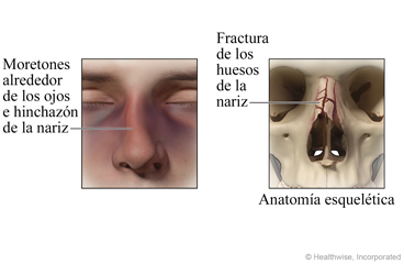 Una nariz fracturada