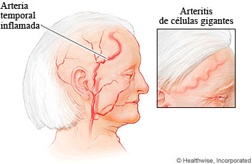 Arteria temporal inflamada.