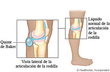 Vista lateral de una rodilla con un quiste de Baker y de una articulación de rodilla normal