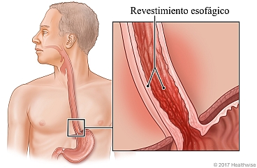 Esófago con detalle de revestimiento esofágico