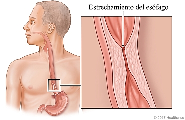 Esophagus with detail of narrow section