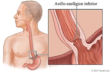 Location of esophagus, with detail of Schatzki's ring.