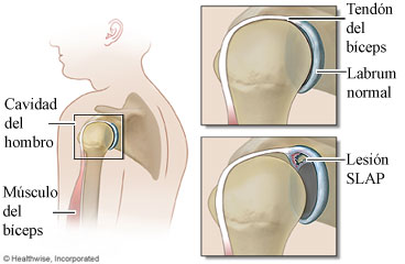 Hombro y lesión SLAP en el hombro