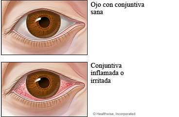 Imagen de un ojo sano y un ojo con conjuntivitis