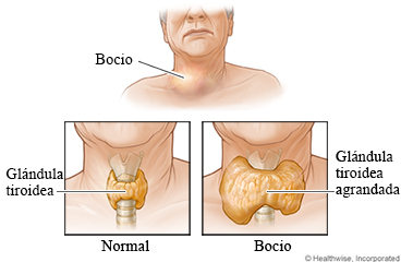 Una glándula tiroidea normal y un bocio
