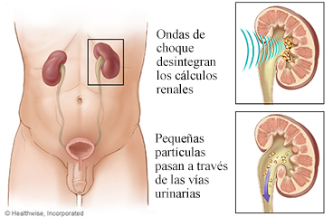 Riñones y litotricia