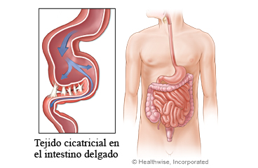 Imagen de adherencias en el intestino delgado