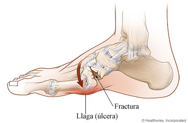 Ilustración de problemas causados por el pie de Charcot