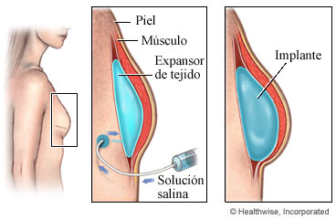 Un expansor de tejido y un implante mamario después de la mastectomía