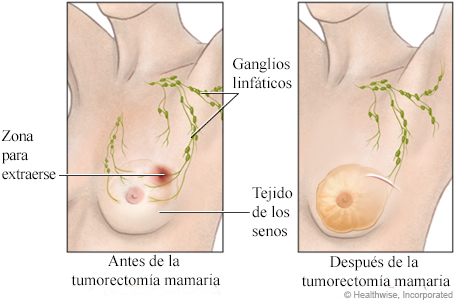 Antes y después de una tumorectomía mamaria