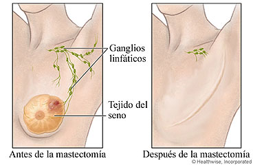 Antes y después de una mastectomía