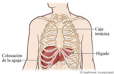 Colocación de una aguja entre dos costillas derechas inferiores para una biopsia de hígado