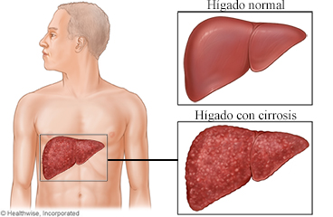 Hígado normal e hígado con cirrosis