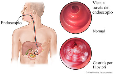 Gastritis vista a través del endoscopio