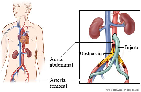 Derivación aortobifemoral