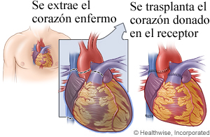 Trasplante de corazón