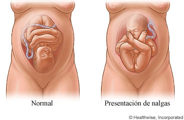 Posición normal y presentación de nalgas de un feto