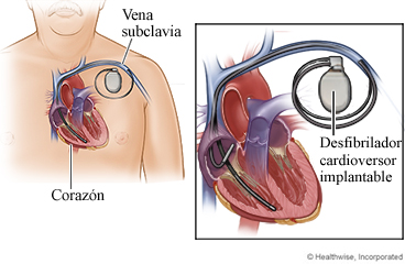 Un corazón y un desfibrilador cardioversor implantable