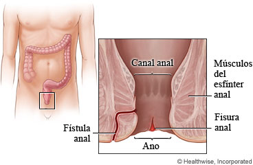 Fístula anal