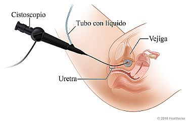 Colocación del cistoscopio por la uretra hasta la vejiga