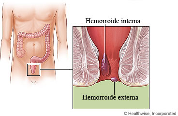 Hemorroides internas y externas