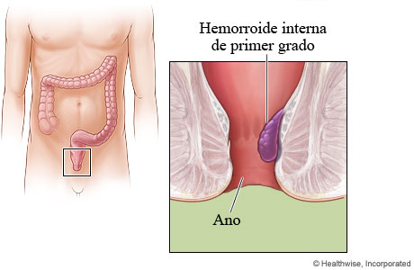 Imagen de una hemorroide interna de primer grado