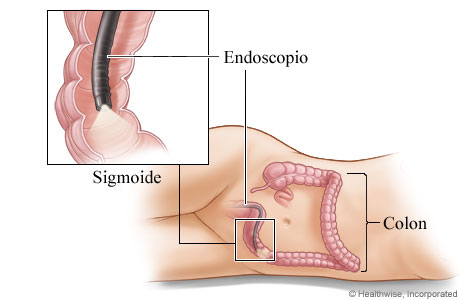 Colonoscopio en el colon