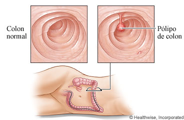 Imagen de un colon normal y de un pólipo de colon