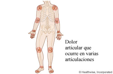 Imagen de las regiones de dolor articular asociadas con la artritis reumatoide