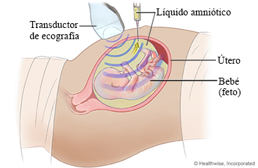 Amniocentesis