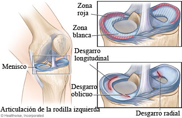 Articulación de la rodilla con desgarros de menisco