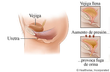 Ubicación de la vejiga y la uretra en el cuerpo, con detalle de vejiga llena que causa pérdidas de orina