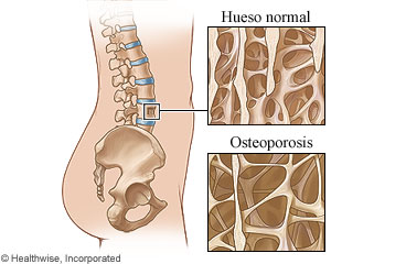 Imagen de un hueso normal comparado con un hueso con osteoporosis