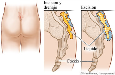 Quiste pilonidal abscedado en la parte superior del pliegue entre las nalgas, con detalle de quiste abierto y drenado, y detalle de quiste extraído.