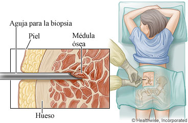 Imagen de la posición boca abajo para una aspiración y biopsia de médula ósea